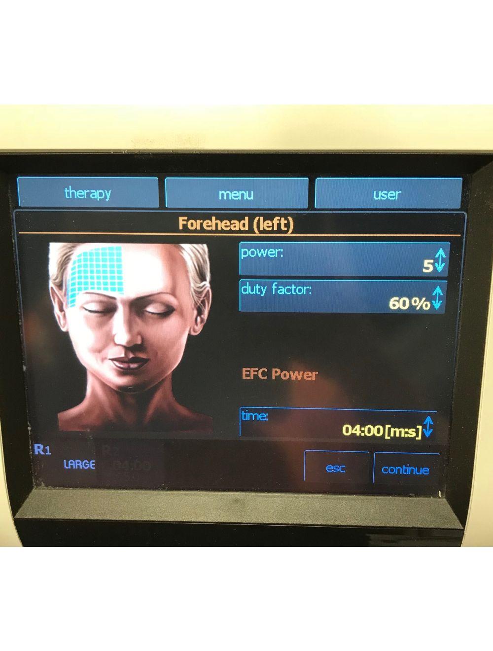 2011 BTL Exilis ELITE RF Radio Frequency 90 Watt Laser Fat Reduction