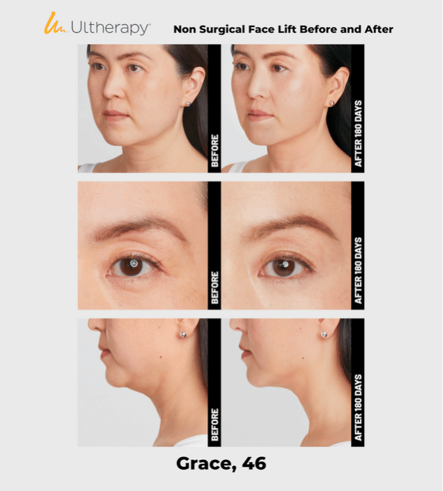 Ulthera Ultherapy DeepSee Transducer DS 4-4.5 (Blue) image 6