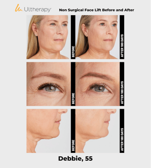 Ulthera Ultherapy DeepSee Transducer DS 7-4.5 (Purple) image 7