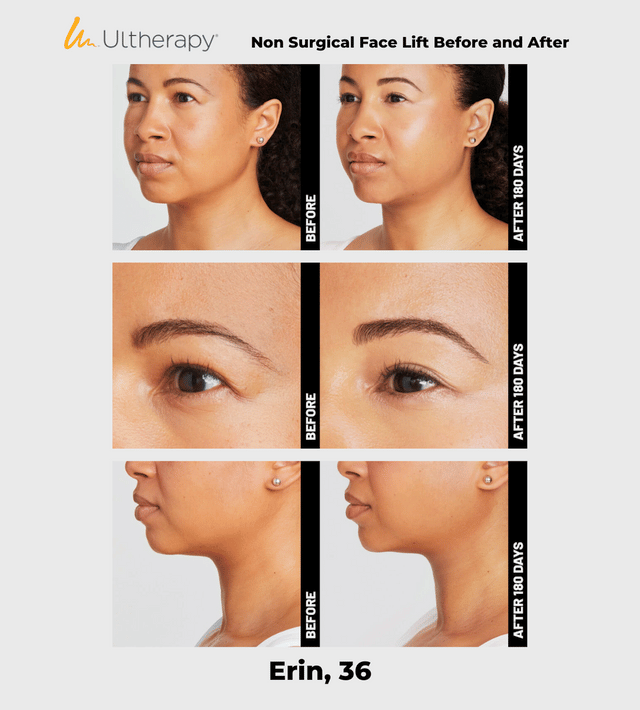 Ulthera Ultherapy DeepSee Transducer DS 7-4.5 (Purple) image 5